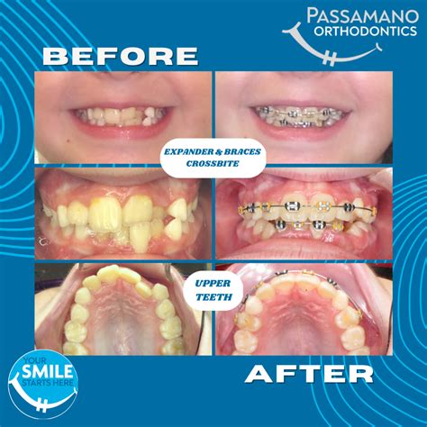 braces auburndale|Orthodontic Braces: What To Expect Before, During, and After.